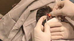 A Head-strong Pilar Cyst